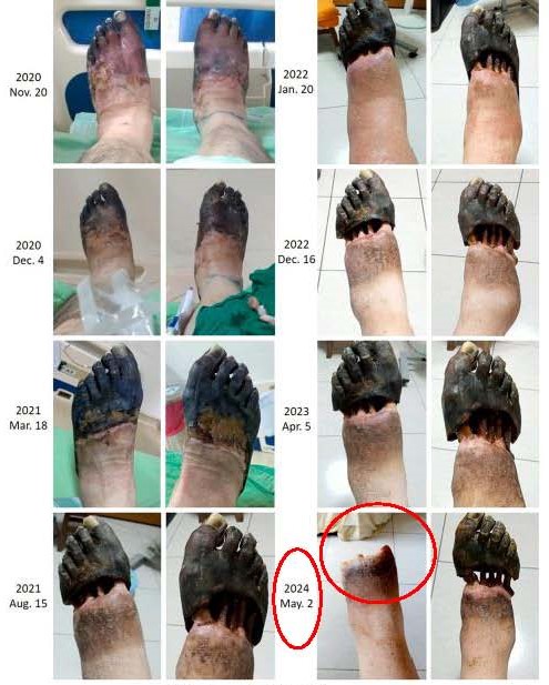 截至目前患者仍然在本院接受中醫治療包括中藥湯劑和中草藥膏劑以用於傷口治療他每天能站立20分鐘從未進行過心臟移植或肢體截肢壞疽的組織自然脫落沒有發生感染02